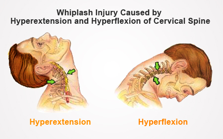Whiplash: What is it and How Does it Affect the Spine